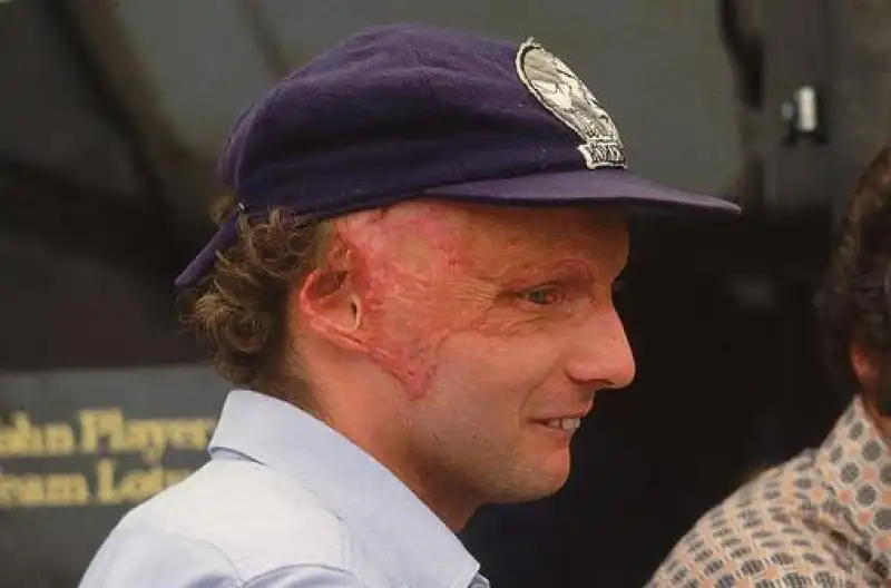 Nel 1976, durante il gran premio di Germania, fu vittima di un grave incidente che gli sfigurò il volto. Lottò per giorni tra la vita e la morte.